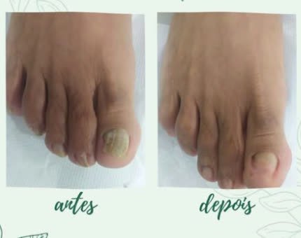 Antes e depois de tratamento de unha na Acássia Podologia