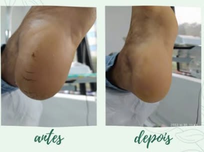 Antes e depois de tratamento de fissuras no calcanhar