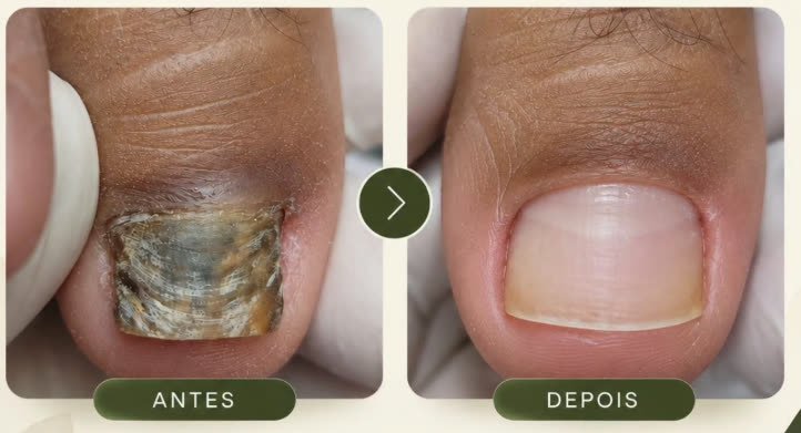 Antes e depois de tratamento de micose de unha