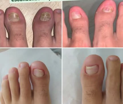 Antes e depois de tratamento de micose nos dois pés