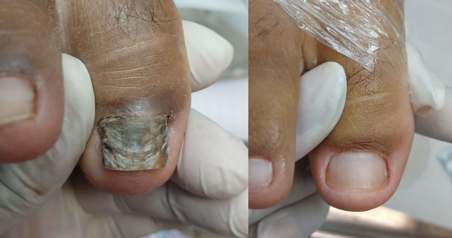 Antes e depois de tratamento de micose de unha na Acássia Podologia