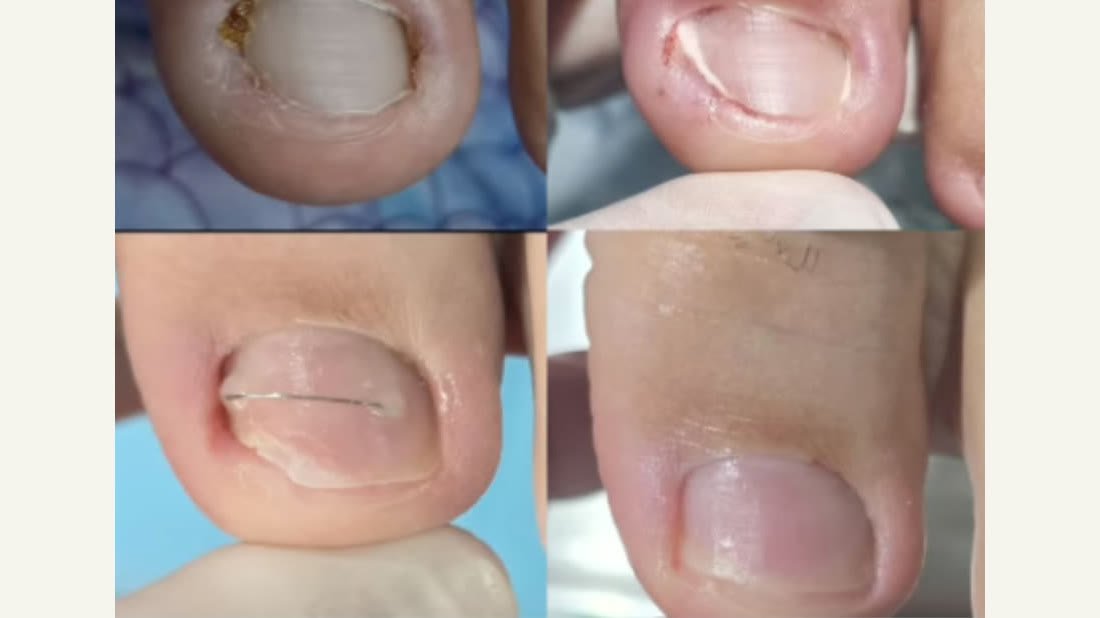 Antes e depois de tratamento de unha encravada e inflamada na Acássia Podologia
